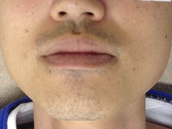 口周りヒゲ脱毛効果 脱毛前