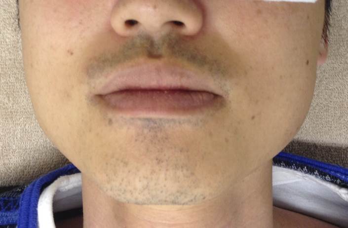 口周りヒゲ脱毛効果 脱毛前