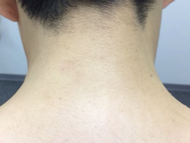 うなじ脱毛効果 脱毛後