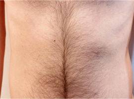 腹毛脱毛効果 脱毛前