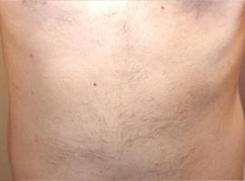 腹毛脱毛効果 脱毛後