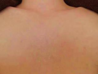 胸毛脱毛効果 脱毛後