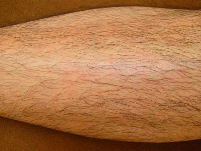 すね毛脱毛効果 脱毛前
