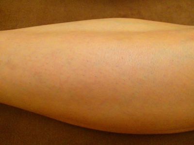 すね毛脱毛効果 脱毛後