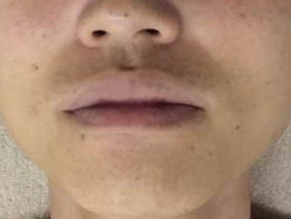 口周りヒゲ脱毛効果 脱毛後