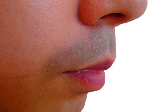 鼻下ヒゲ脱毛効果 脱毛前