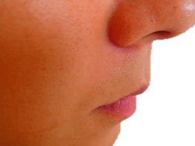 鼻下ヒゲ脱毛効果 脱毛後