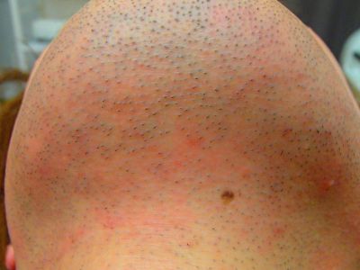 あご下ヒゲ脱毛効果 脱毛前