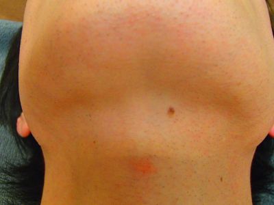 あご下ヒゲ脱毛効果 脱毛後 width=