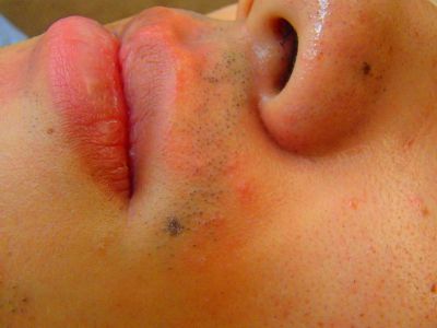 鼻下ヒゲ脱毛効果 脱毛前