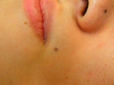 鼻下ヒゲ脱毛効果 脱毛後