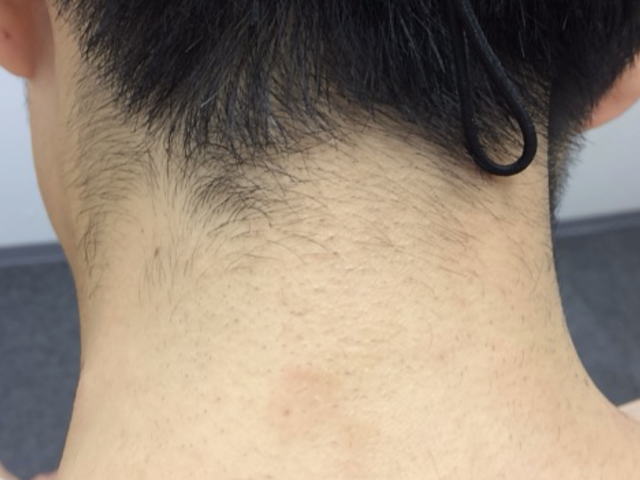 うなじ脱毛効果 脱毛前