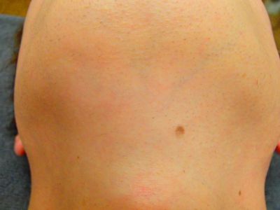 あごひげ脱毛After