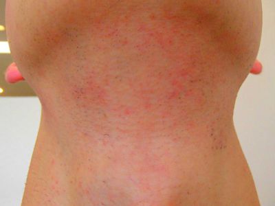 あごひげ脱毛After