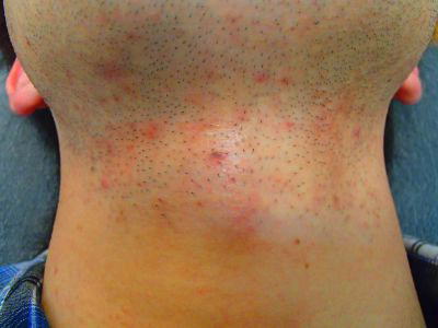 あごひげ脱毛前