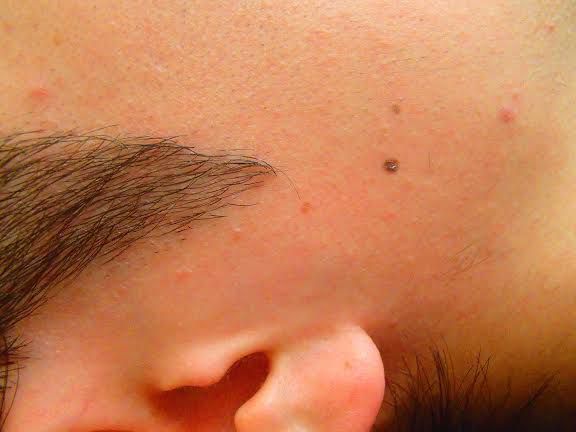 あごひげ脱毛After