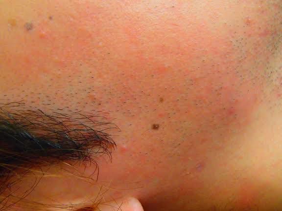 あごひげ脱毛前