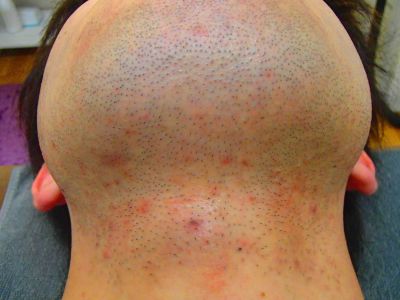 うなじ脱毛効果 脱毛前